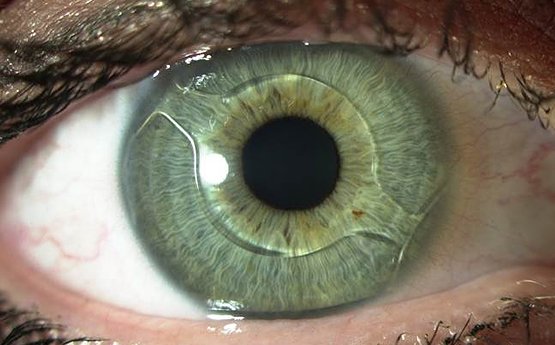 lentes-intra-oculares